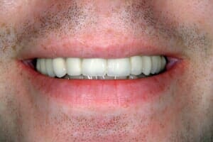 After Dental Implant — Sarasota, FL — Sterling Dental