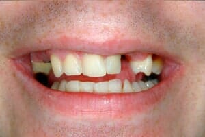 Missing Teeth — Sarasota, FL — Sterling Dental
