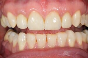 After Cleaning Teeth — Sarasota, FL — Sterling Dental