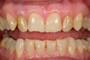 Uncleaned Teeth — Sarasota, FL — Sterling Dental