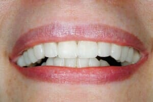 Beautiful Cleaned Teeth — Sarasota, FL — Sterling Dental