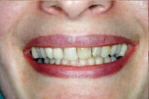 Teeth With Tartar — Sarasota, FL — Sterling Dental