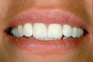 Teeth After Dental Procedure — Sarasota, FL — Sterling Dental