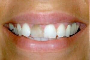 Teeth With Damage — Sarasota, FL — Sterling Dental