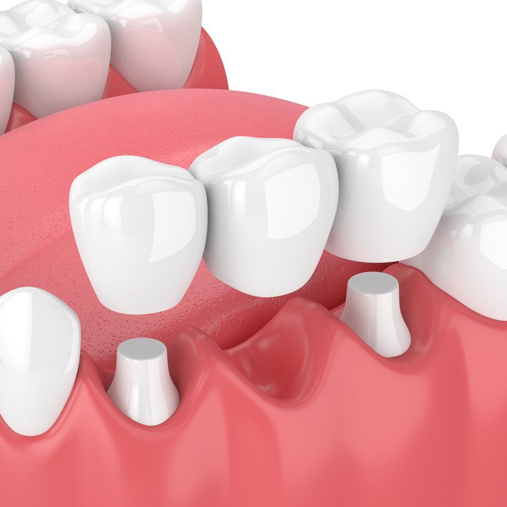 Dental Bridges — Sarasota, FL — Sterling Dental Dental Bridges — Sarasota, FL — Sterling Dental
