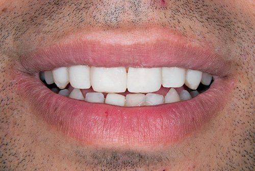 after smile