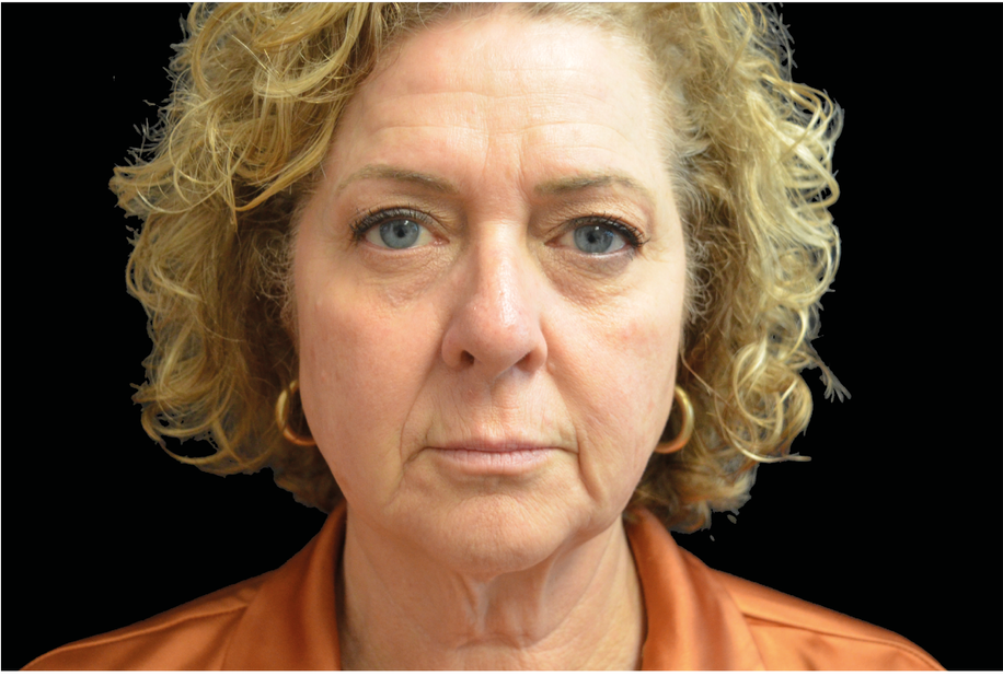 EMFACE TREATMENT