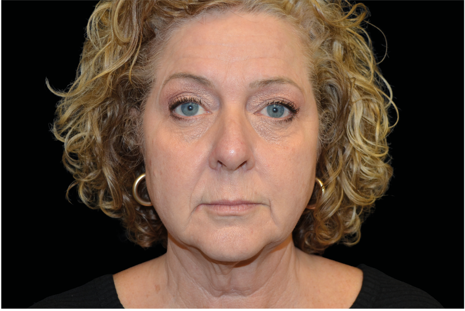 EMFACE TREATMENT