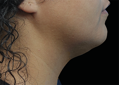 EMFACE EYES TREATMENT