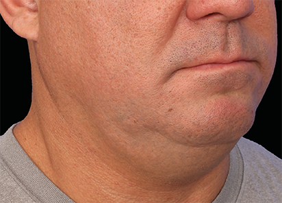 EMFACE EYES TREATMENT