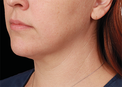 EMFACE EYE TREATMENT