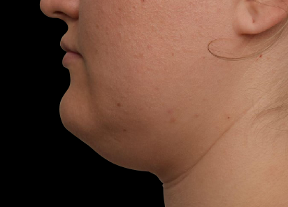 EMFACE EYES TREATMENT