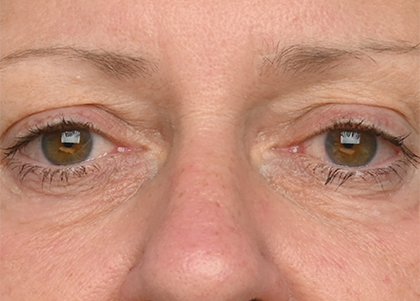 EMFACE EYES TREATMENT