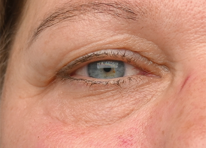 EMFACE EYE TREATMENT