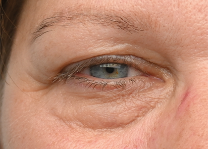 EMFACE EYE TREATMENT