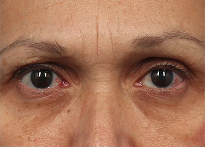 EMFACE EYES TREATMENT
