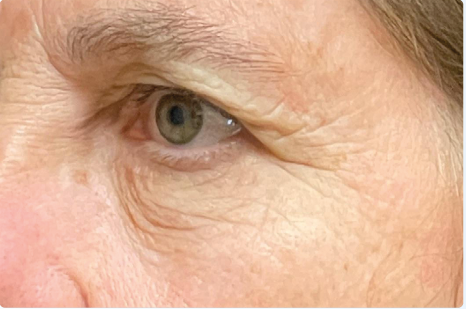 EMFACE EYES TREATMENT