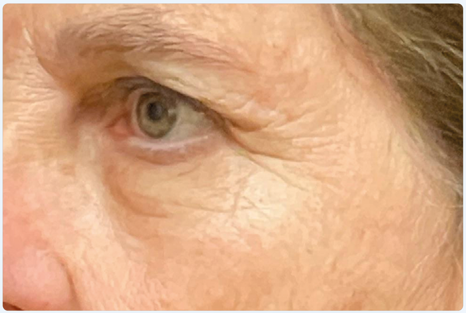 EMFACE EYES TREATMENT
