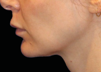 EMFACE TREATMENT