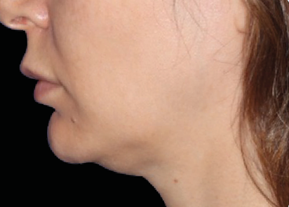 EMFACE TREATMENT