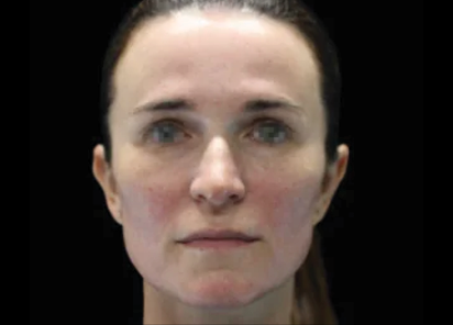 EMFACE TREATMENT