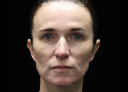 EMFACE TREATMENT