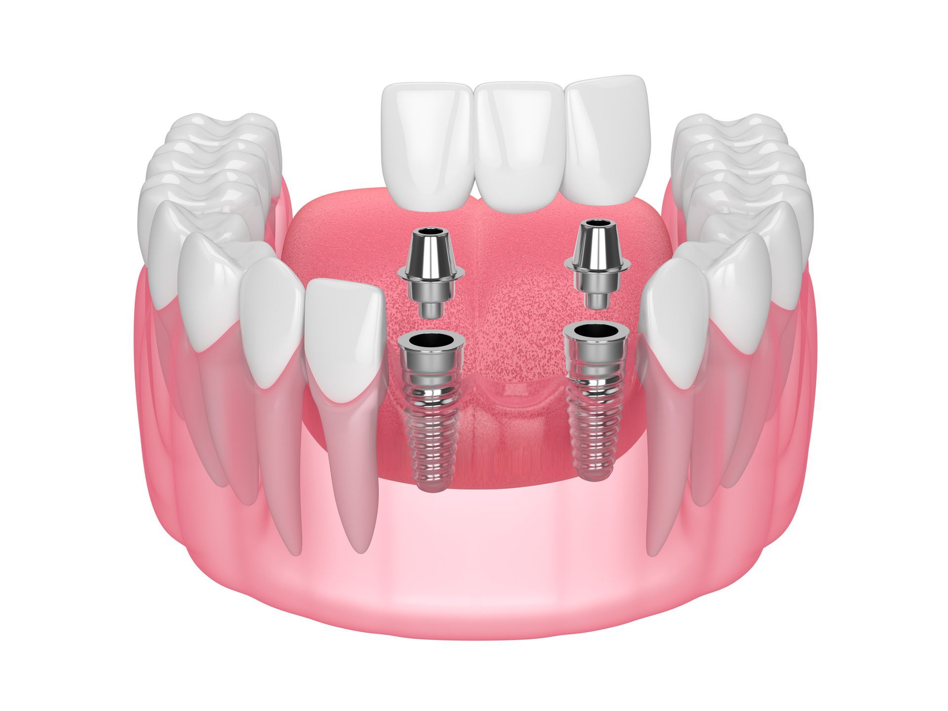 A 3d rendering of a dental bridge with four dental implants.