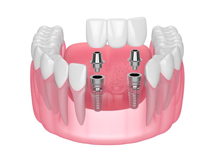 A 3d rendering of a dental bridge with four dental implants.