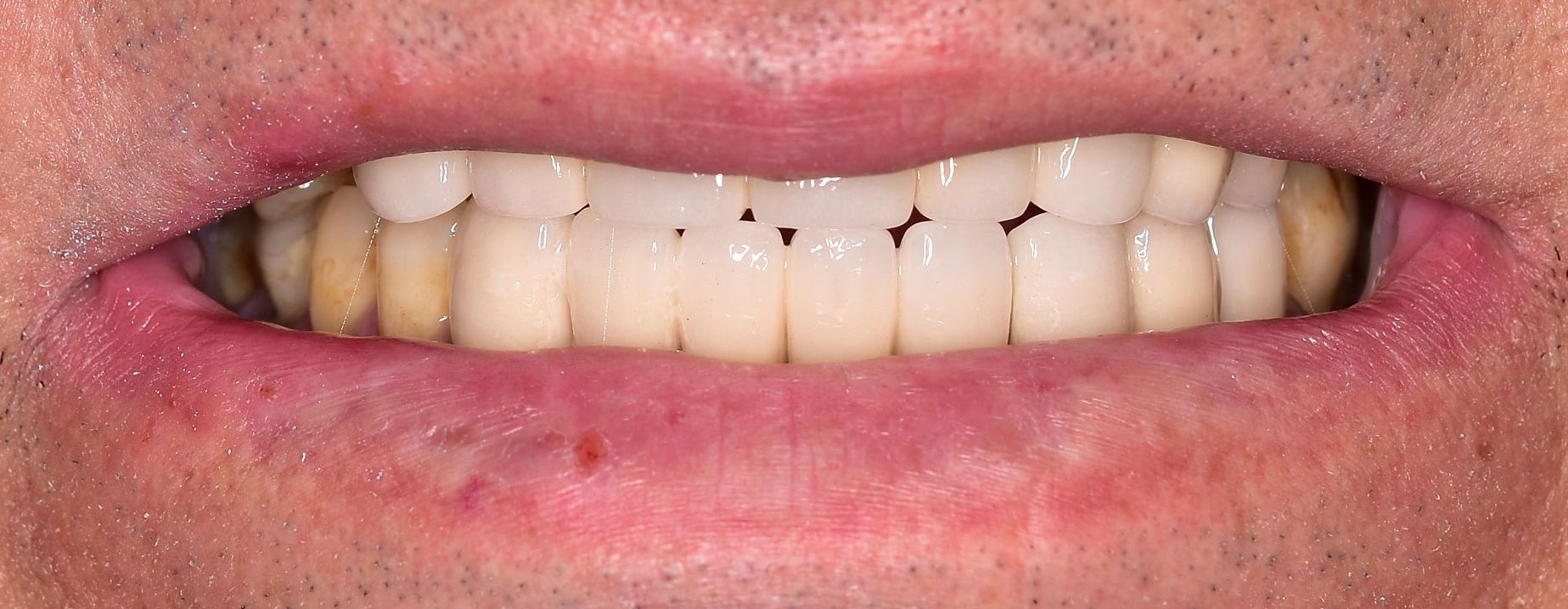 after smile