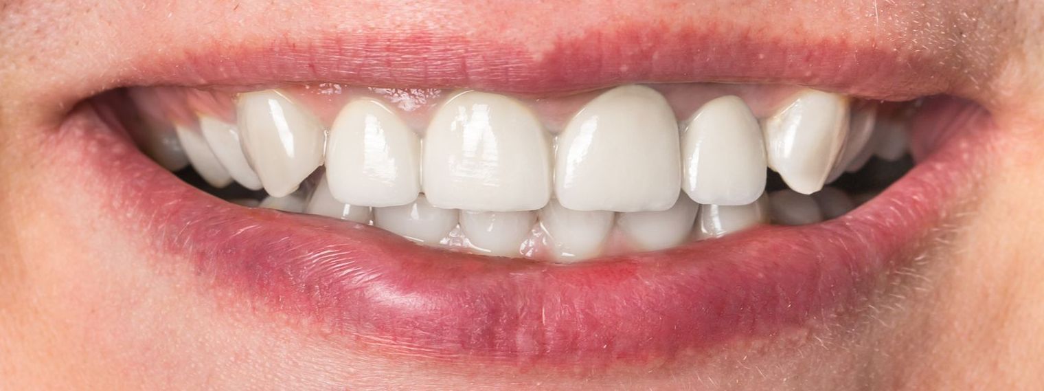 after smile