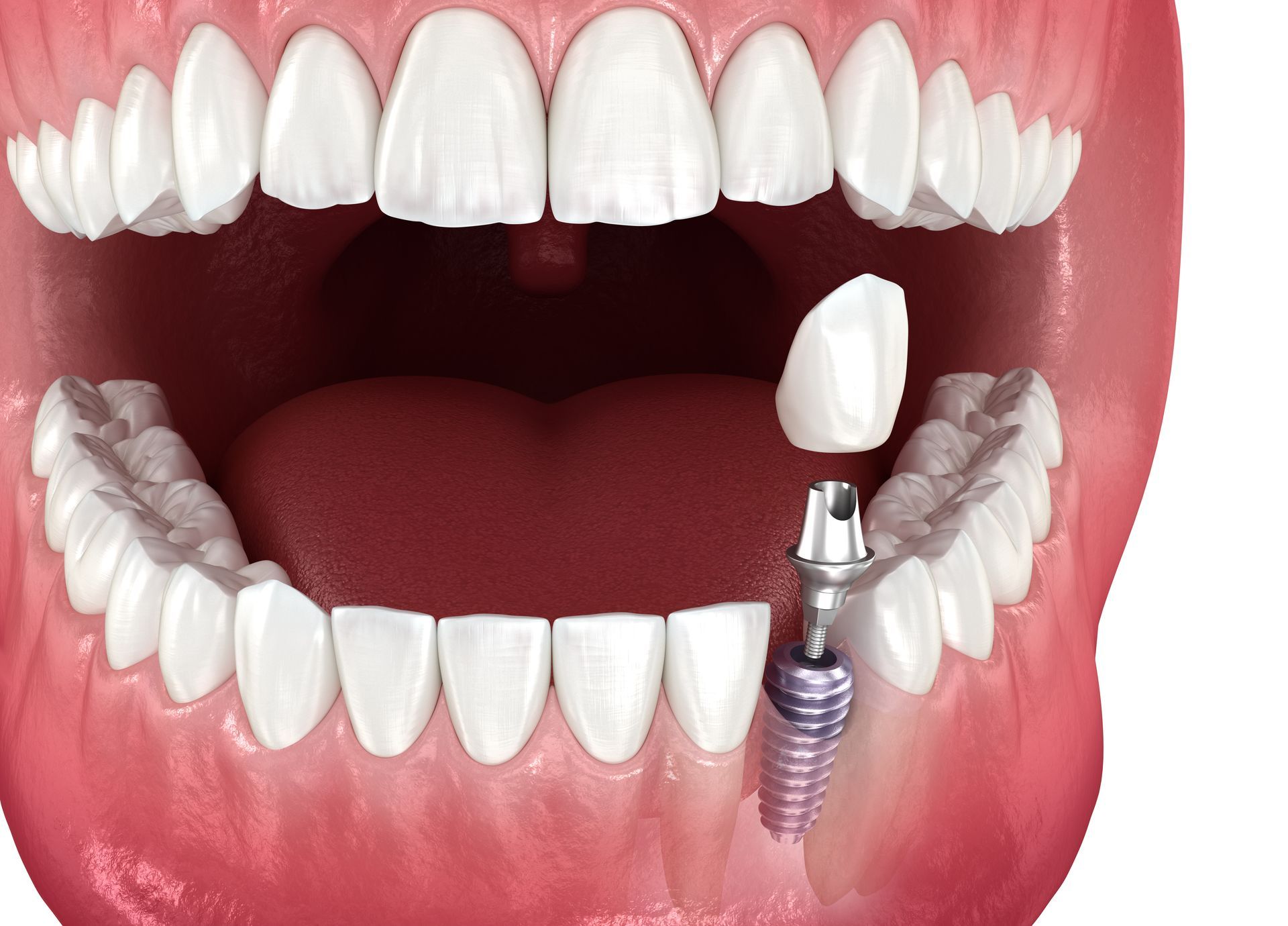 A close up of a person 's mouth with a dental implant in it