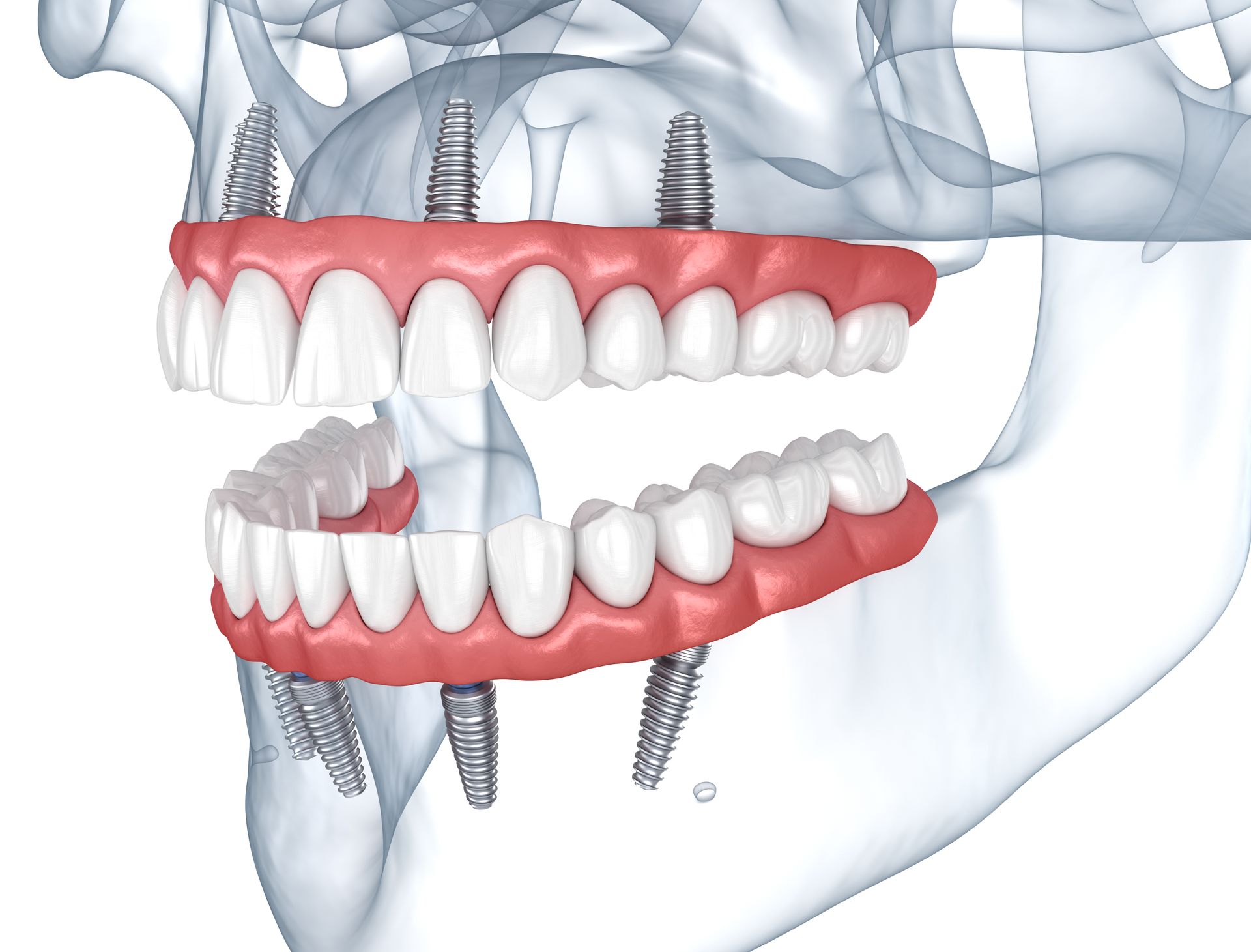 A computer generated image of a person 's teeth and skull