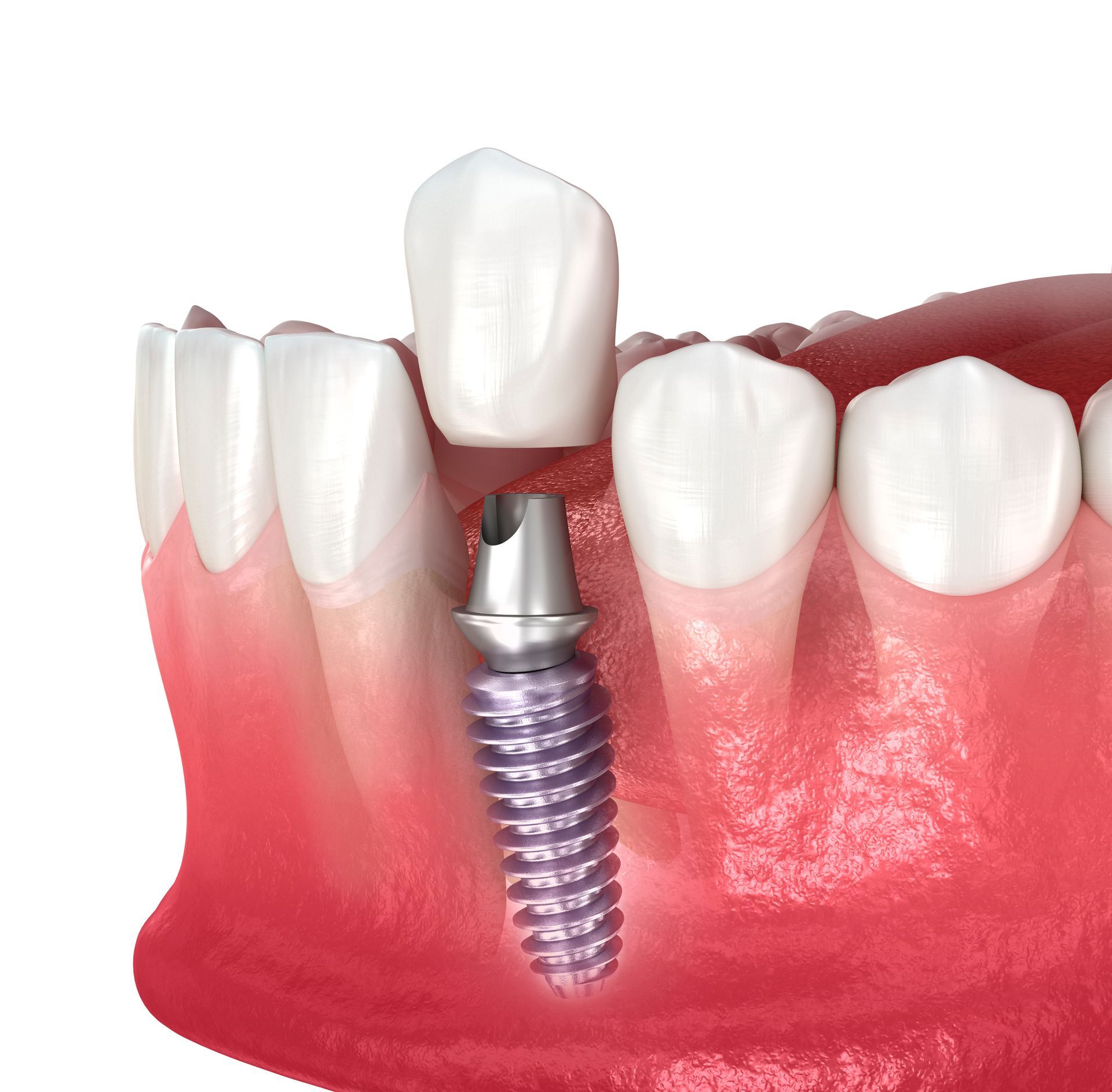 A model of a tooth with a dental implant in it