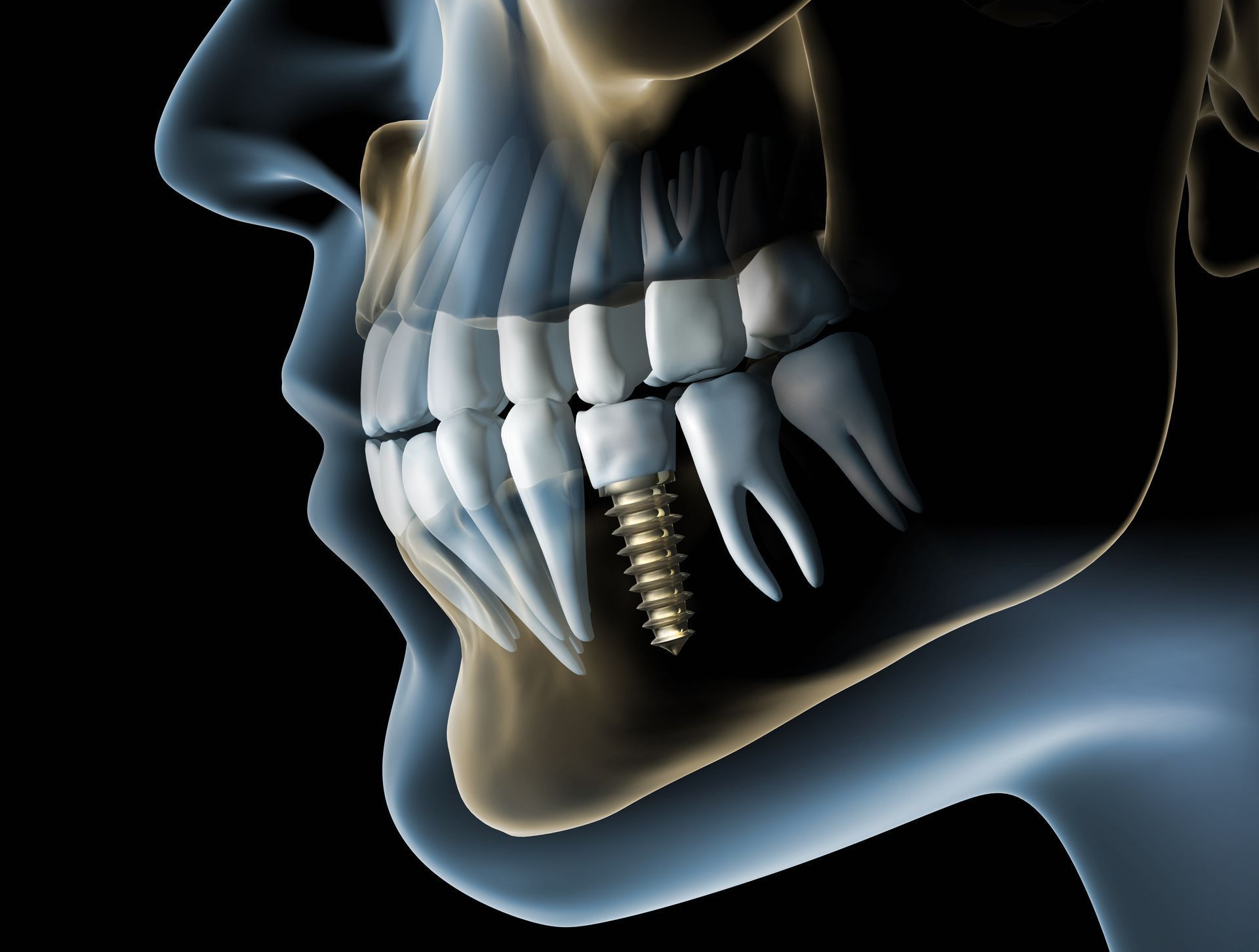 A close up of a person 's teeth with a screw in it