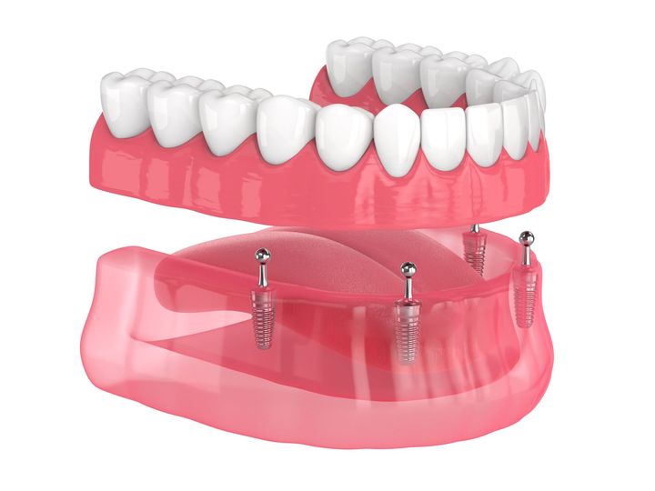 A 3d rendering of a full denture with dental implants.