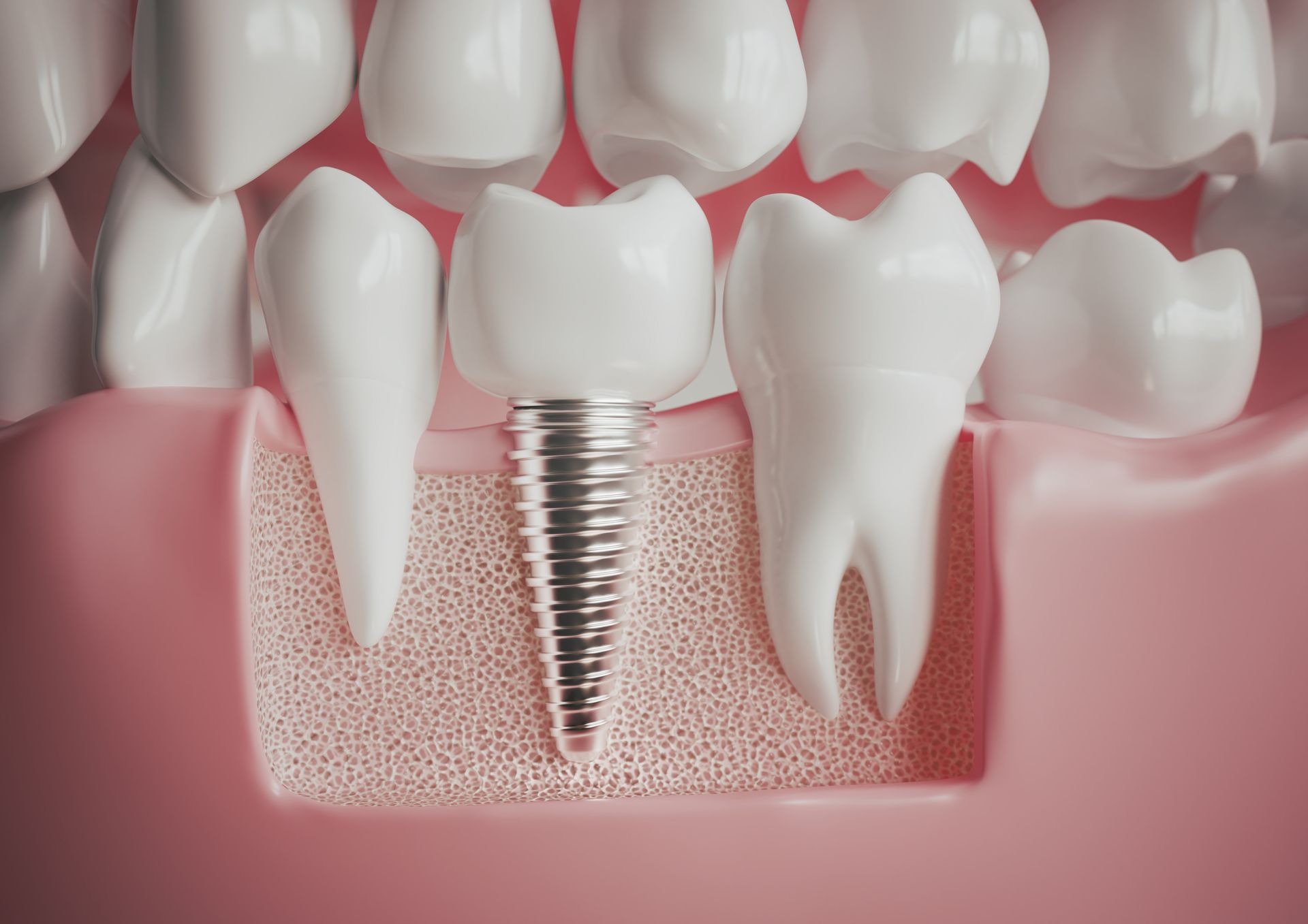 Implant