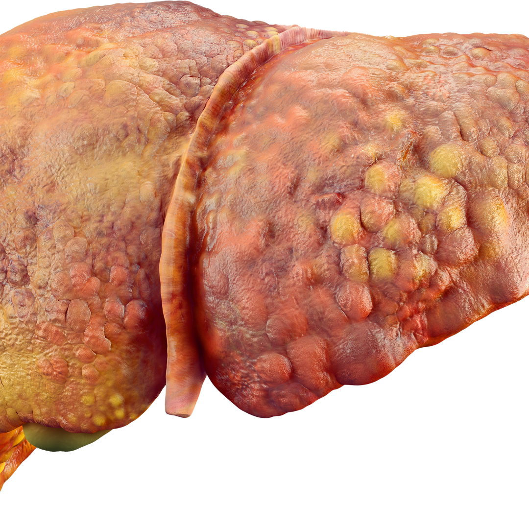 steatosi: cause, sintomi e trattamento
