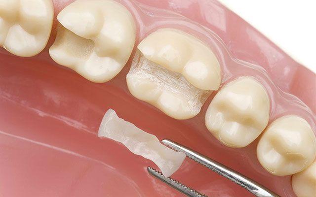 DR. MARCO TULIO CÁRDENAS - Bracket cerámico