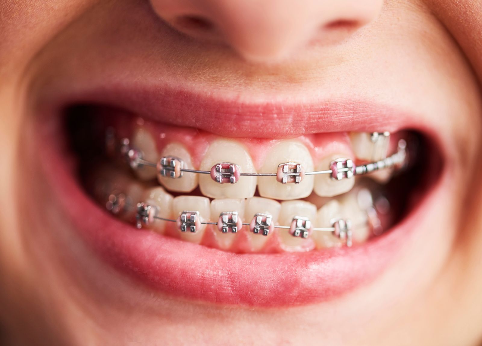 Primer plano de la boca de una persona que muestra los dientes con aparatos de ortodoncia metálicos y alambres.