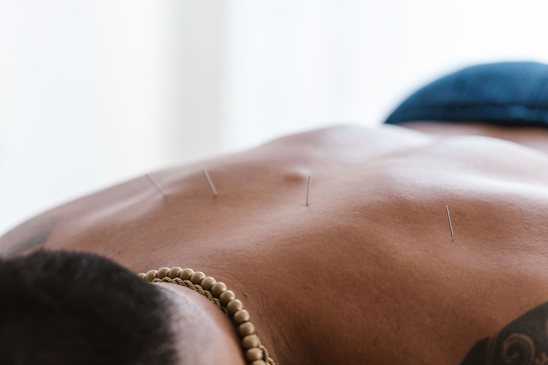 Dry needling being performed on a patient's back at Tampa Bay Physical Therapy