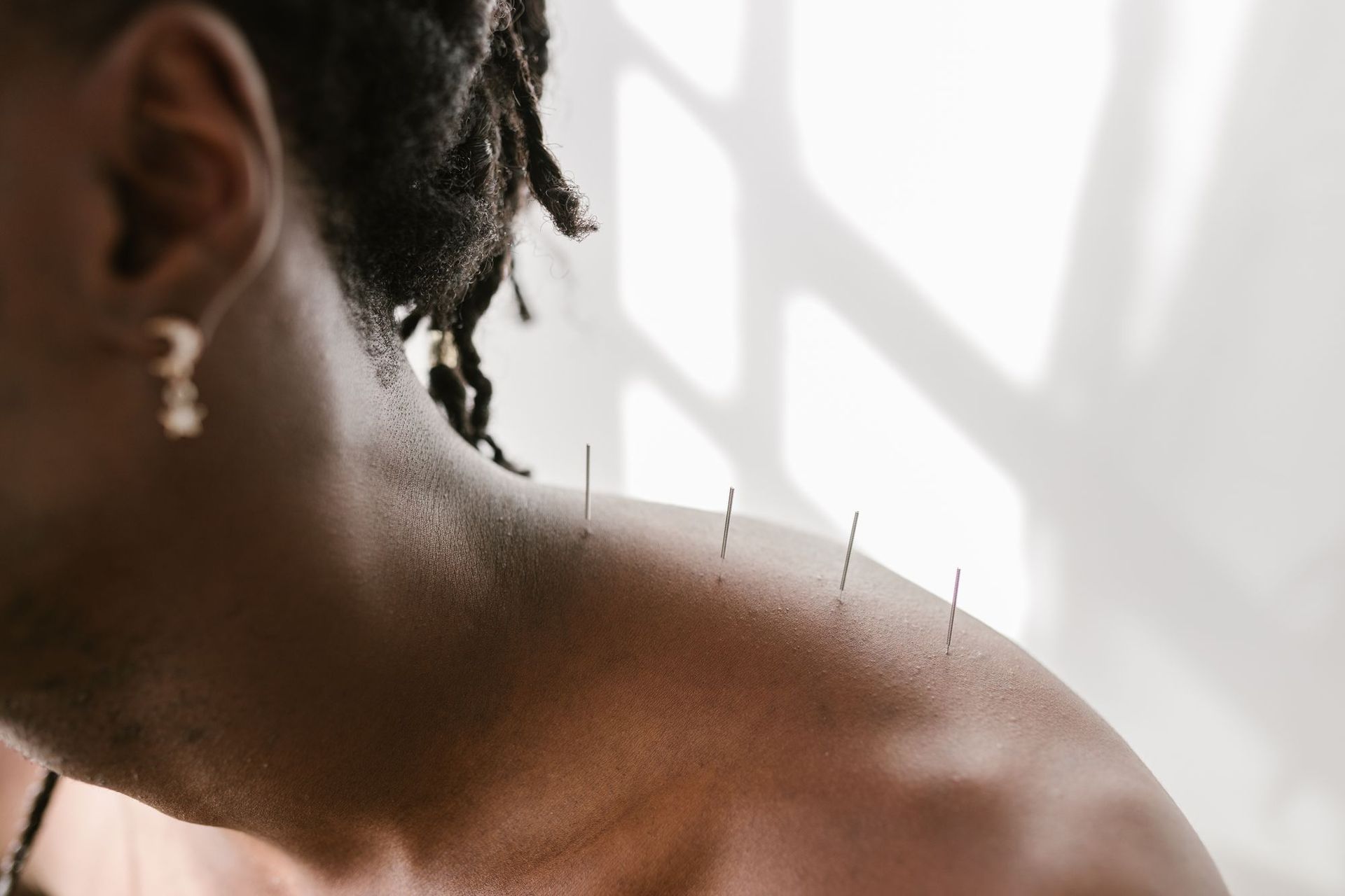 Dry needling of the shoulder at Tampa Bay Physical Therapy