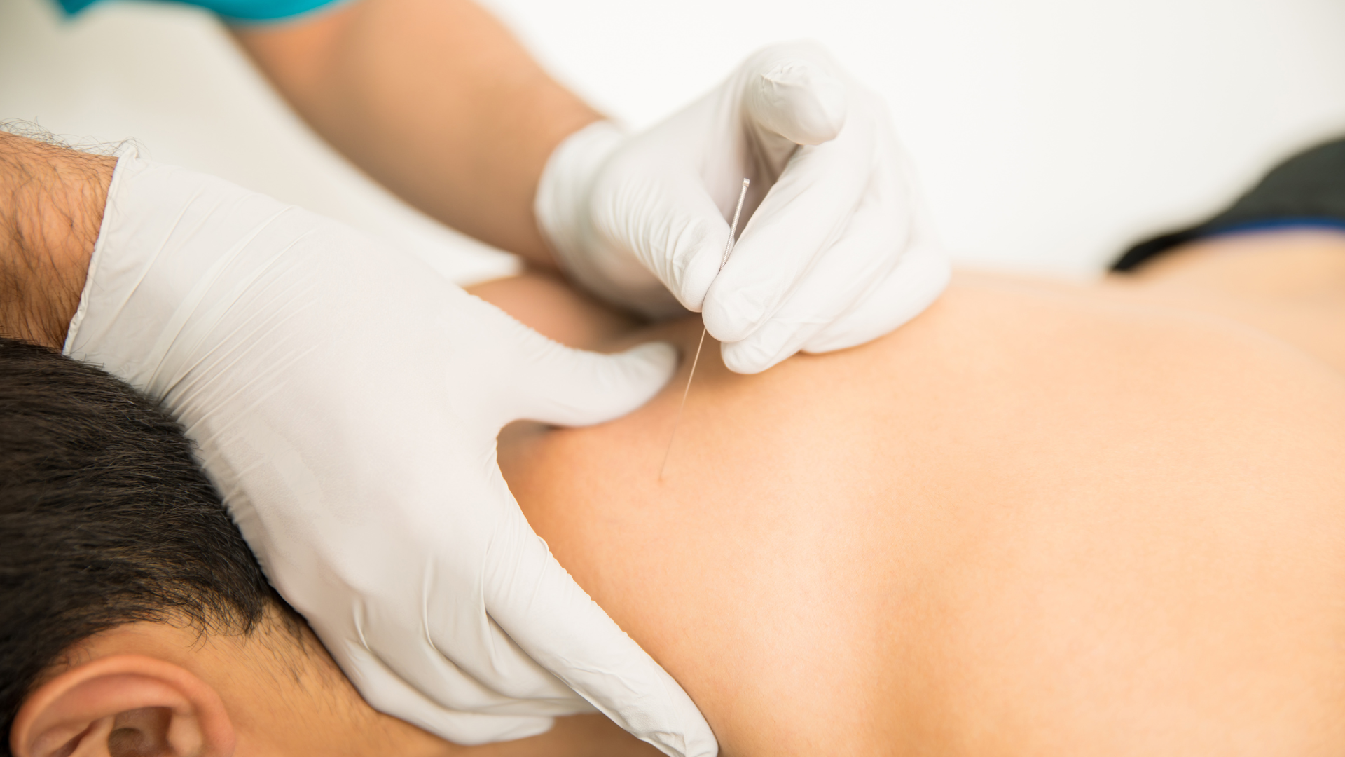 Dry needling of the upper back at Tampa Bay Physical Therapy