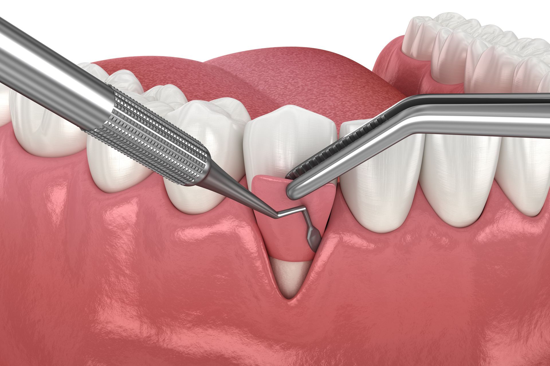 Digital illustration of a periodontic procedure.