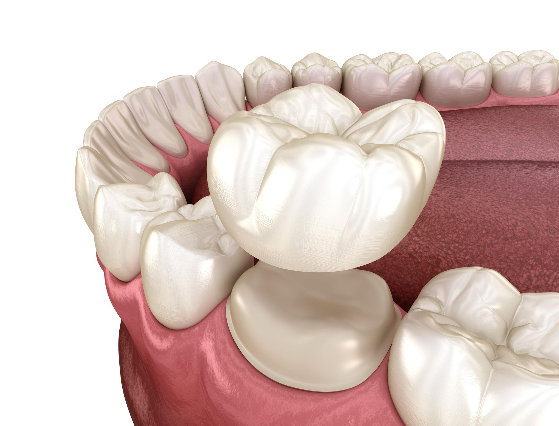 Digital illustration of a crown lengthening procedure.