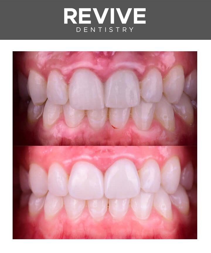 Before and after comparison photos of a Revive Dental patient.