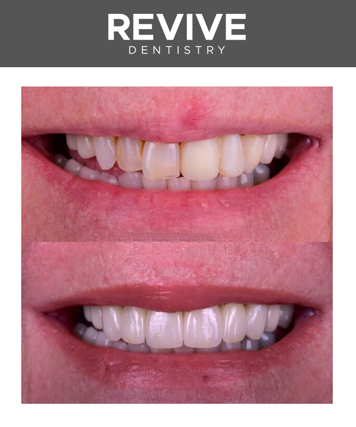 Before and after comparison photos of a Revive Dental patient.