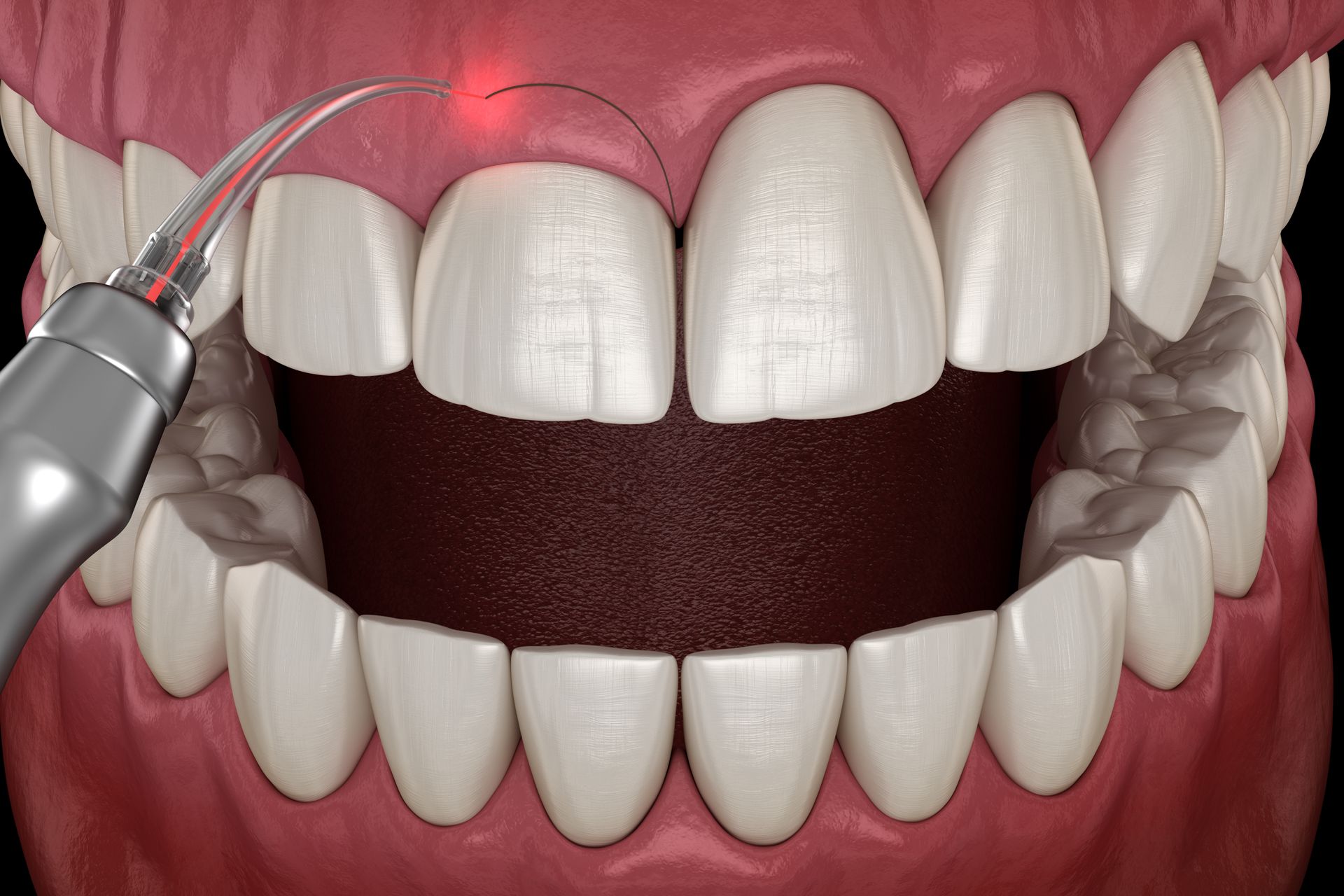 Digital illustration of gum contouring.