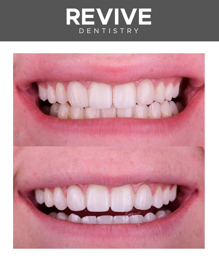 Before and after comparison photos of a Revive Dental patient.