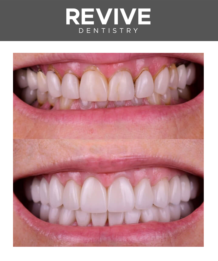 Before and after comparison photos of a Revive Dental patient.