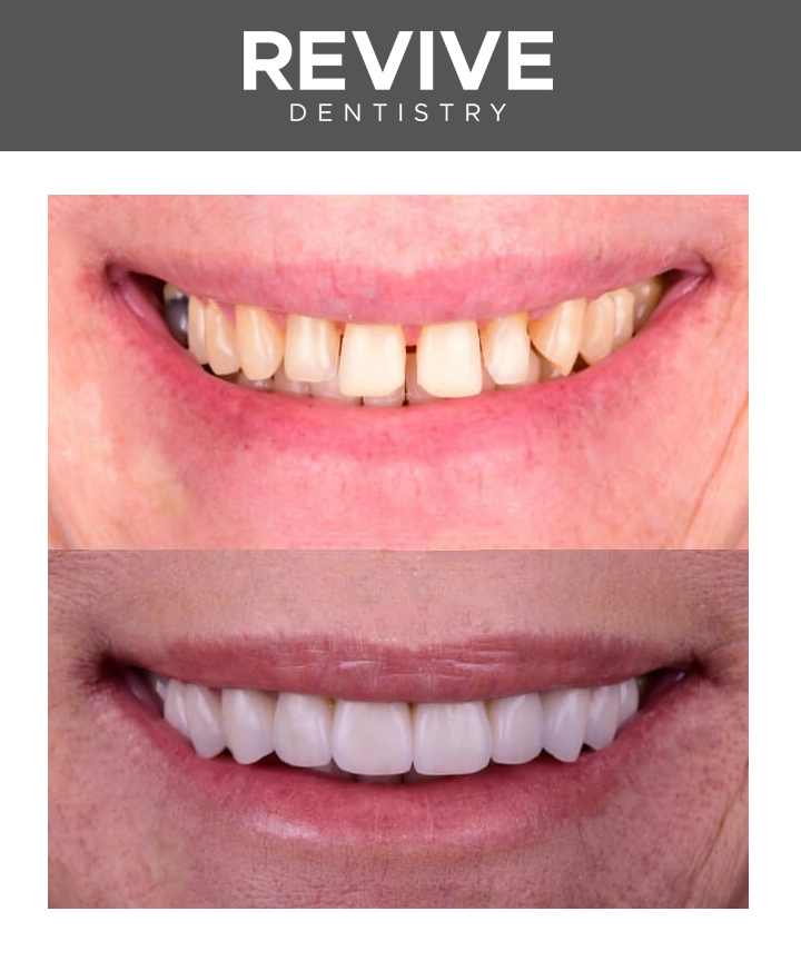 Before and after comparison photos of a Revive Dental patient.